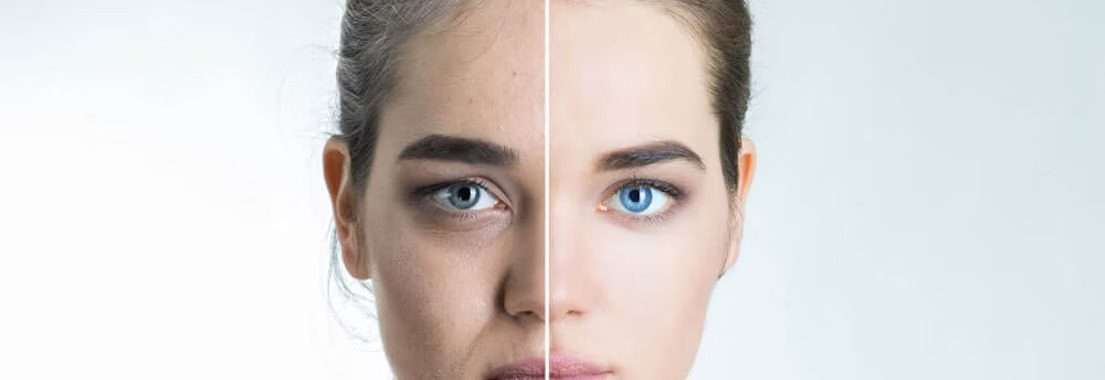 Facial-wrinkles-dermal-fillers-botox