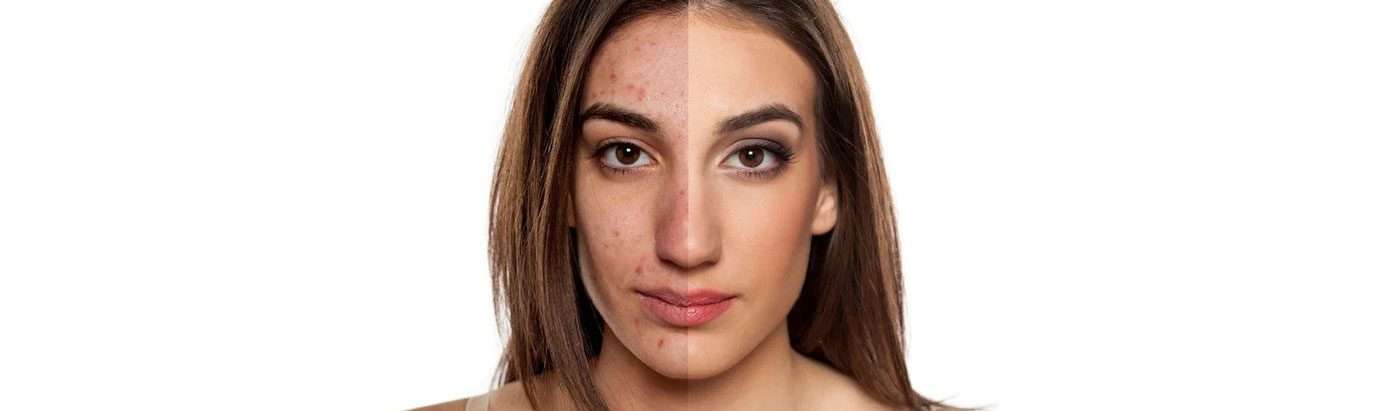 Reduce-facial-scars