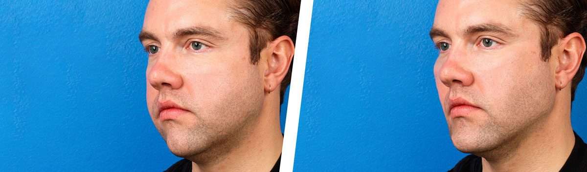 Strengthen-Chin-Jawline