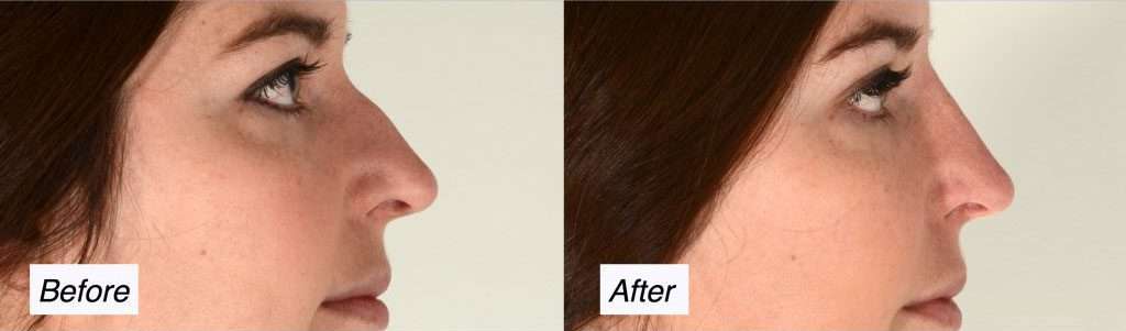 nonsurgical-rhinoplasty