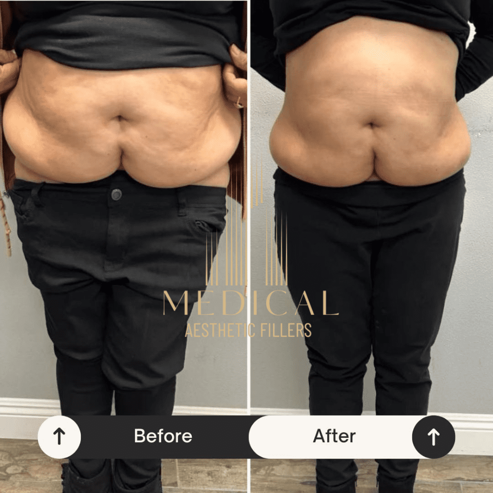 Mesotherapy Injections for Weight Loss